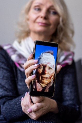 Olena Kurilo (ukrainienne) montrant une photo de ses blessures dûes à la guerre en Ukraine